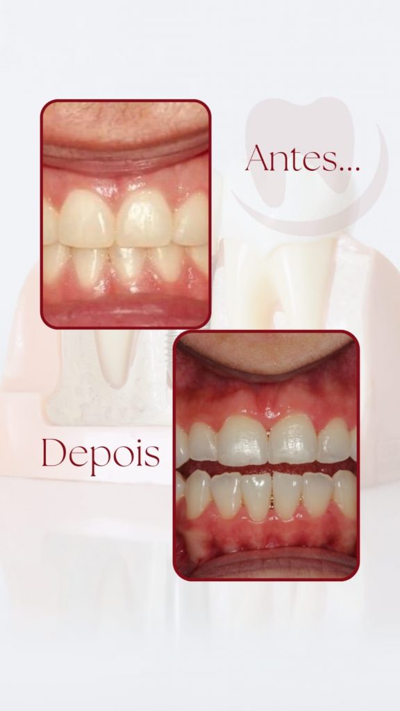 Clareamento Dental Antes E Depois Neo Sorriso