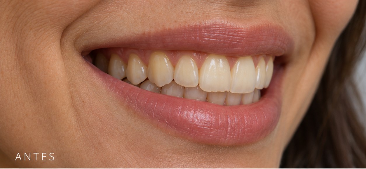Simulação de sorriso antes do clareamento