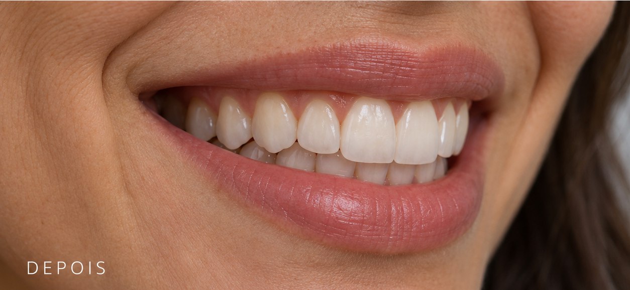Simulação de sorriso após clareamento