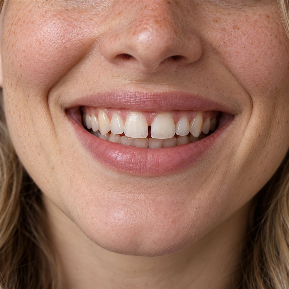 Antes: lentes de contato dental (simulação ilustrativa)
