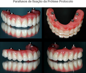 Prótese Protocolo » Dentistas Curitiba » Ortodontia, Prótese, Implante